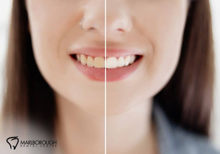 How Often To Get Professional Teeth Whitening |Teeth Whitening Calgary